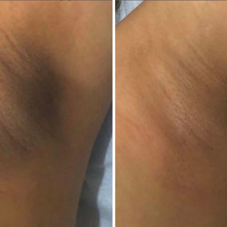 Kimberly taylor client #1 - underarm hyperpigmentation with line_2