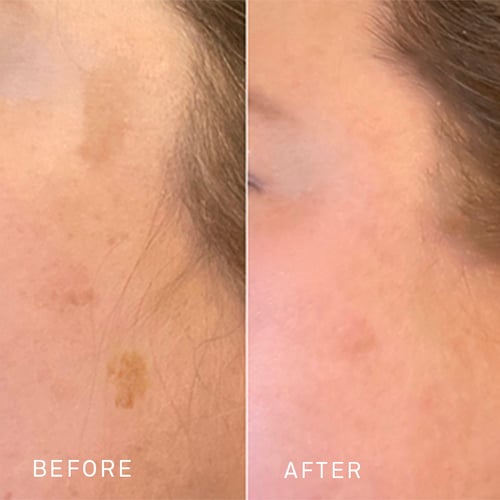 Sun damage, blog@2x