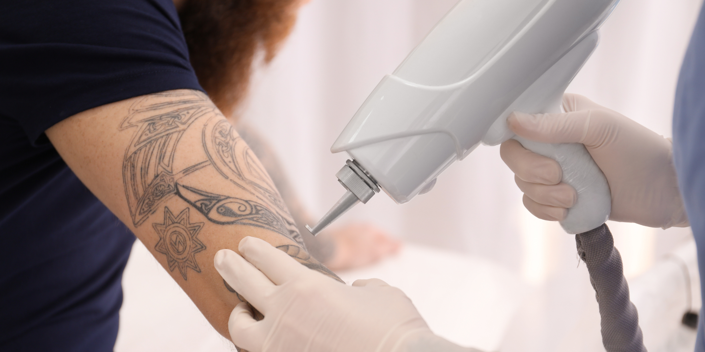 laser tattoo removal blisters  VIVA Concept Technology Co Ltd